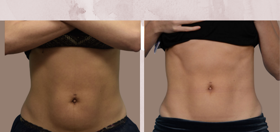 Bodysculp Treatment Before and After Stomach Photos | Imagine Medspa in Winter Garden, FL