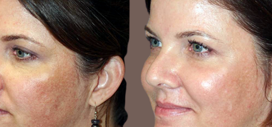 Erbium Resurfacing Treatment Before and After results | Imagine Medspa in Winter Garden, FL