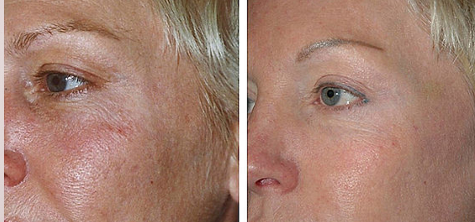 Erbium Resurfacing Treatment Before and After results | Imagine Medspa in Winter Garden, FL