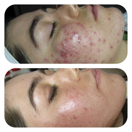 Face Reality Skincare Acne Treatment Before and After Photos | Imagine Medspa in Winter Garden, FL