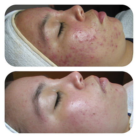 Face Reality Skincare Acne Treatment Before and After Photos | Imagine Medspa in Winter Garden, FL