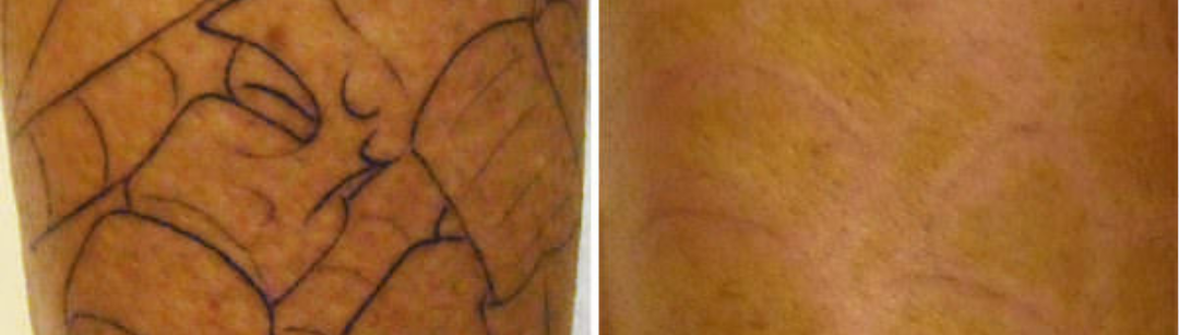 Tattoo Removal Before and After Photos | Imagine Medspa in Winter Garden, FL