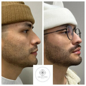 Young Male Before and After Getting Morpheus8 RF Microneedling | Imagine Medspa in Winter Garden, FL