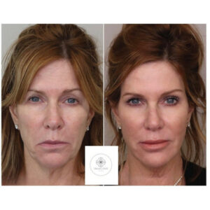 Young Female Before and After Getting Morpheus8 RF Microneedling | Imagine Medspa in Winter Garden, FL