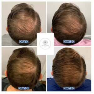 Young Male Head before and after Hair Restoration treatment | Imagine Medspa in Winter Garden, FL