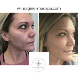Young Female Before and After Getting Botox | Imagine Medspa in Winter Garden, FL