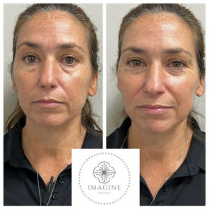 Female Before and After Getting Botox | Imagine Medspa in Winter Garden, FL