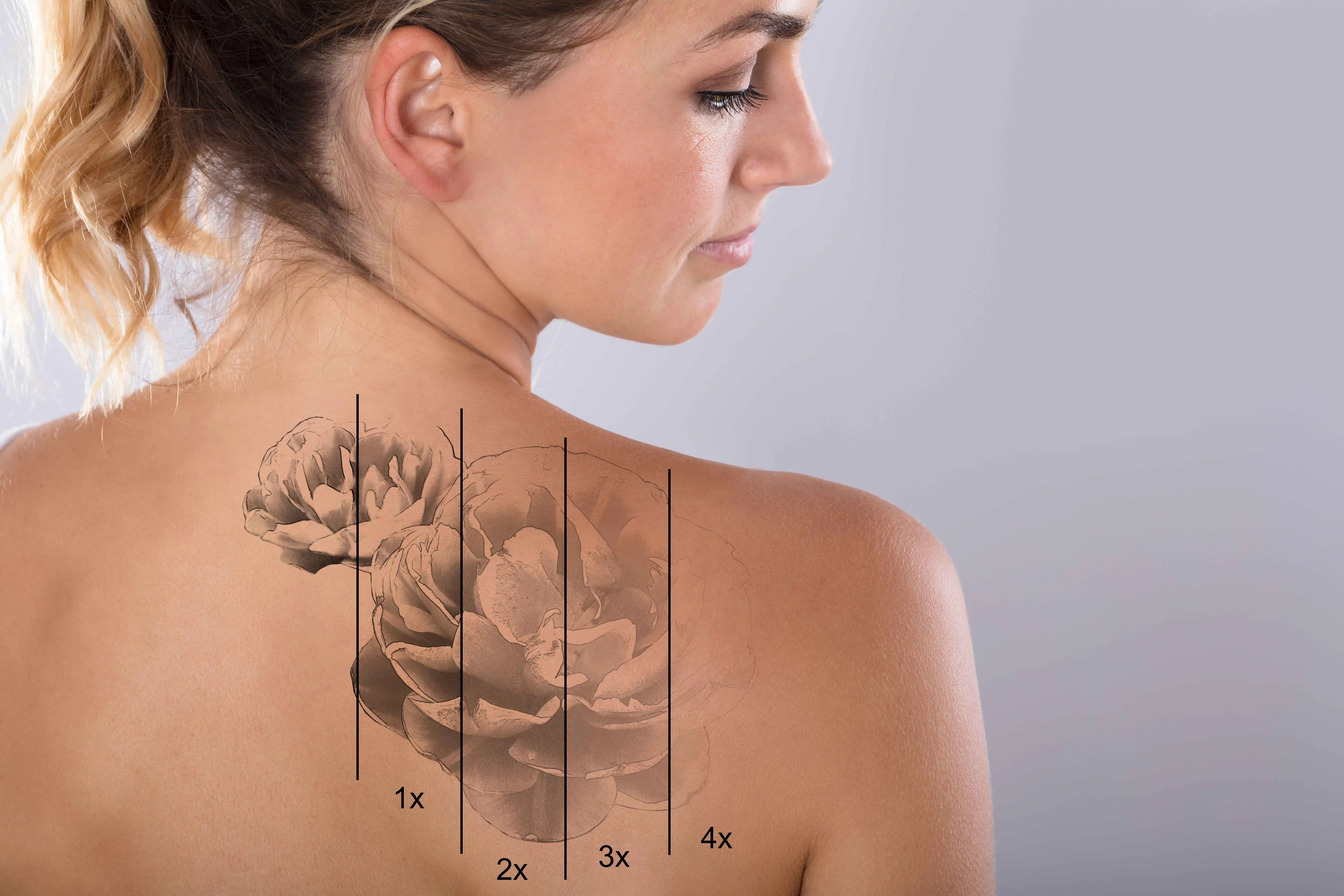 Laser Tattoo Removal by Imagine MedSpa in Winter Garden, FL