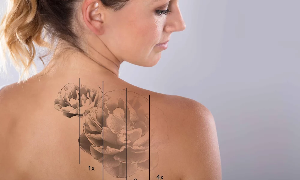 Laser Tattoo Removal by Imagine MedSpa in Winter Garden, FL