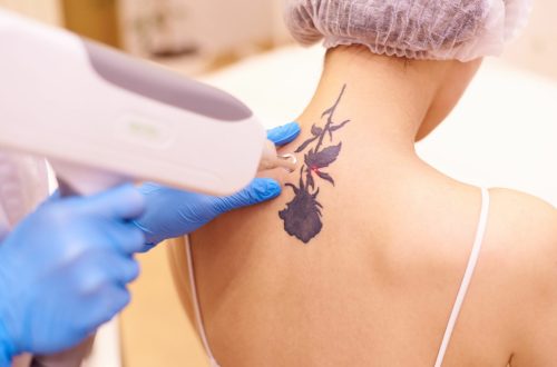 Young Woman Getting Laser Tattoo Removal Treatment | Imagine Medspa in Winter Garden, FL