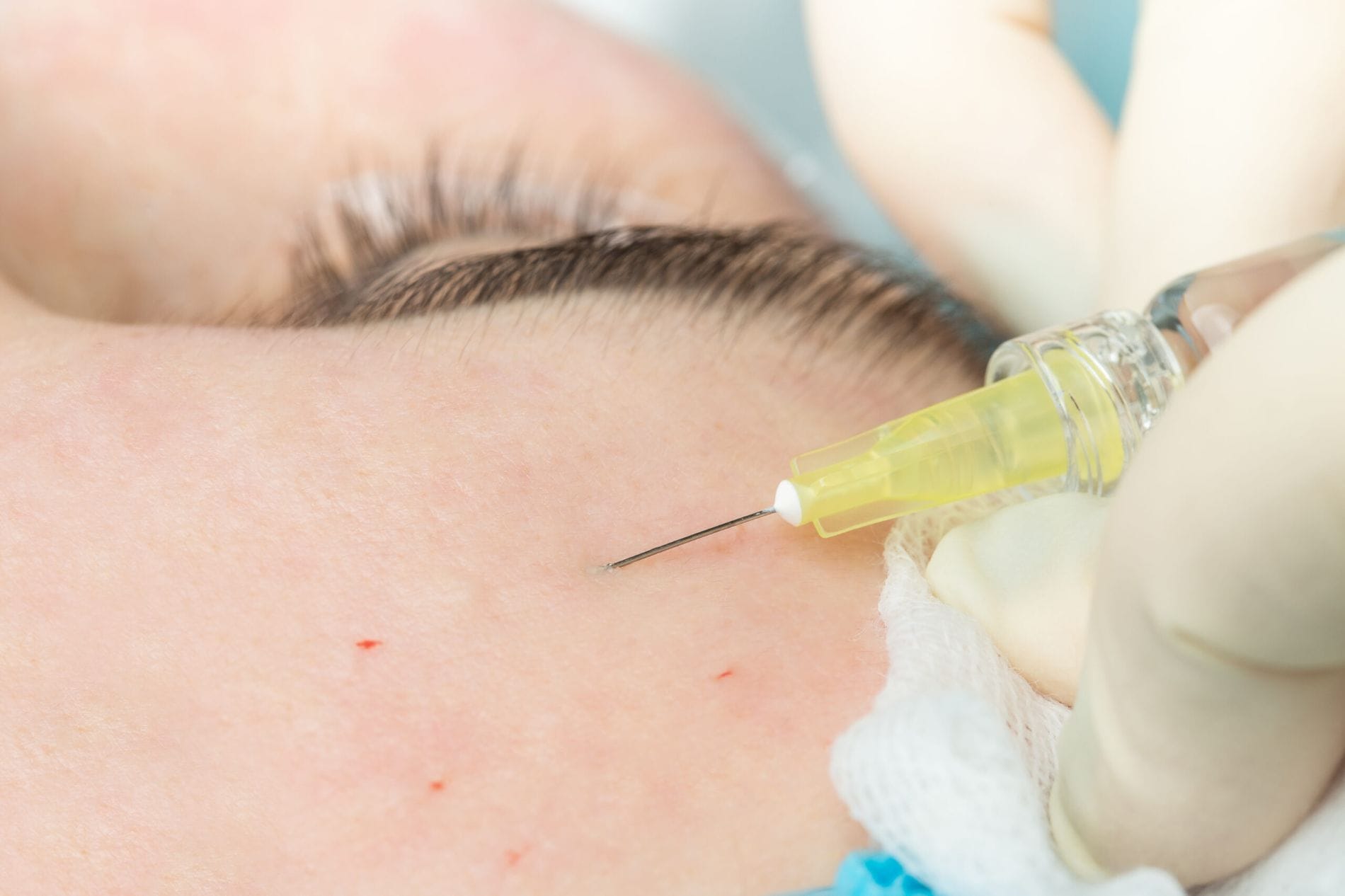PDO Thread Lift Treatments By Imagine Medspa in Winter Garden, FL