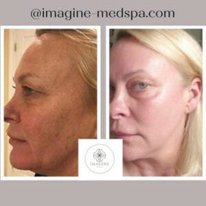 Female Before and After Getting Botox | Imagine Medspa in Winter Garden, FL