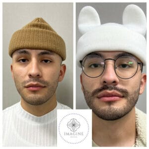 Before and After Getting Botox | Imagine Medspa in Winter Garden, FL