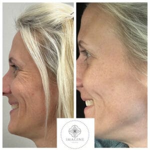 Before and After Getting Botox | Imagine Medspa in Winter Garden, FL