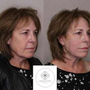 Before and After Images at Imagine Medspa in Winter Garden, FL
