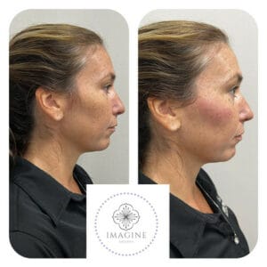 Before and After Images at Imagine Medspa in Winter Garden, FL