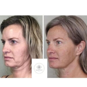 Before and After Images at Imagine Medspa in Winter Garden, FL