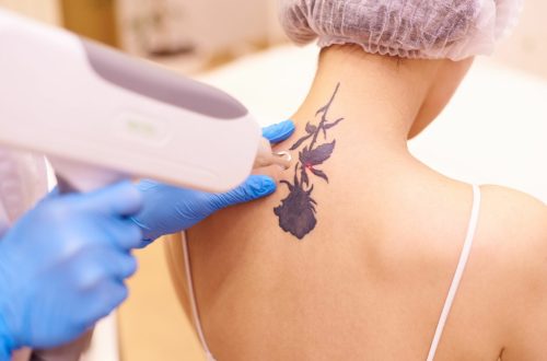 Laser Vascular Reduction Treatment By Imagine Medspa in Winter Garden, FL