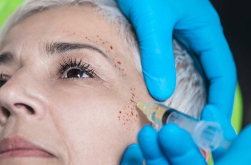 Vampire Facial Treatments By Imagine Medspa in Winter Garden, FL